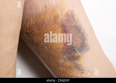 Jambes de femme après une chirurgie de varices, avec sutures chirurgicales visibles, points de suture et plaies sur une jambe. Traitement curatif, procédures esthétiques, thromboses Banque D'Images