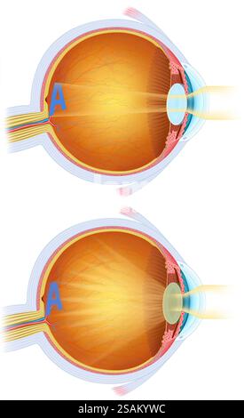 Illustration de deux images du foyer visuel de l'œil. L'une est normale, et l'autre a une cataracte oculaire, opacification progressive du cristallin. Banque D'Images