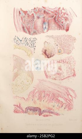 Les bactéries et leur rôle dans l'anatomie et l'histologie pathologiques des maladies infectieuses, Paris, F. Alcan, 1885, Bacteria, infections bactériennes, pathogénicité, pathologie, cette illustration met en valeur diverses vues microscopiques liées à une étude de la diphtérie et des tubercules de l’espèce gallinacée (volaille). La section supérieure présente des tissus enflammés avec des changements cellulaires notables, tandis que les cadres suivants représentent différents échantillons pathologiques. Chaque partie étiquetée fournit des informations détaillées sur les structures affectées par la maladie, mettant en évidence les interactions cellulaires et inflammatoires Banque D'Images