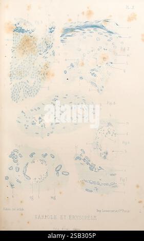 Les, bactéries, et, leur, rôle, dans, l'anatomie, et, l'histologie, pathologiques, des, maladies, infectieuses, Paris, F, Alcan, 1885, bactéries, bactériennes, infections, pathogénicité, pathologie, cette illustration présente une série d’études détaillées axées sur la variole et l’érysipèle, décrivant divers schémas et formes associés à ces affections. Les éléments visuels comprennent des groupes de formes ressemblant à des cellules et à des lésions, annotées avec des lettres et des chiffres pour référence. La section supérieure montre une distribution de petites entités circulaires, représentant éventuellement des pustules ou des vésicules. Le cen Banque D'Images