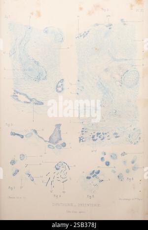 Les bactéries et leur rôle dans l'anatomie et l'histologie pathologiques des maladies infectieuses, Paris, F. Alcan, 1885, Bacteria, infections bactériennes, pathogénicité, pathologie, cette représentation visuelle présente des illustrations anatomiques détaillées liées à la diphtérie et à la dysenterie. La mise en page comprend diverses figures étiquetées systématiquement, montrant des vues microscopiques d'échantillons de tissus et d'agents pathogènes impliqués dans ces maladies. Les subtilités des structures cellulaires et la morphologie de différents micro-organismes sont décrites, fournissant un examen scientifique de leurs attributs physiques Banque D'Images