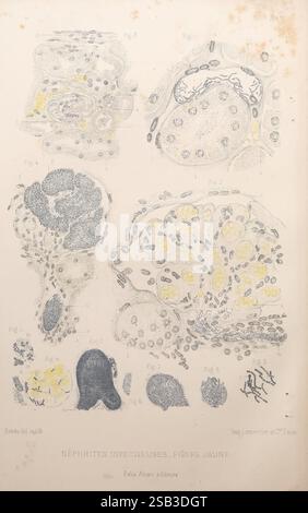 Les bactéries et leur rôle dans l'anatomie et l'histologie pathologiques des maladies infectieuses, Paris, F. Alcan, 1885, Bacteria, infections bactériennes, pathogénicité, pathologie, l’illustration présente une série de diagrammes cellulaires détaillés liés à la néphrite et à la fièvre jaune infectieuse. Plusieurs figures mettent en évidence différents stades des cellules rénales et les caractéristiques pathologiques associées, mettant en évidence les changements structurels observés dans la néphrite. Chaque figure est méticuleusement étiquetée avec des annotations numériques, fournissant une référence claire aux structures cellulaires distinctes et à leurs interactions. Le Banque D'Images