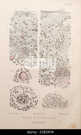Les, bactéries, et, leur, rôle, dans, l'anatomie, et, l'histologie, pathologiques, des, maladies, infectieuses, Paris, F, Alcan, 1885, bactéries, bactériennes, infections, pathogénicité, pathologie, cette illustration présente une série de diagrammes scientifiques détaillés axés sur la structure des bacilles tuberculeux. Les images sont étiquetées avec des références numériques et fournissent un examen rapproché de diverses formations cellulaires associées à la maladie. Chaque section met en évidence des caractéristiques morphologiques distinctes des bacilles, soulignant leur relation avec les tissus environnants. Feat. Clé Banque D'Images