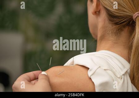 Traitement par acupuncture des douleurs chroniques à l'épaule. Banque D'Images