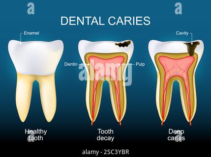 La carie dentaire. Dent saine, carie dentaire et caries profondes. Coupe transversale d'une dent humaine avec une couche d'émail au niveau de la couronne, de la cavité, de la pulpe et de la dentine. Illustration de Vecteur
