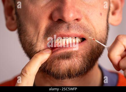 Homme tenant un cure-dents dentaire en caoutchouc montrant des gencives saignantes, maladie des gencives causée par une mauvaise hygiène buccale Banque D'Images
