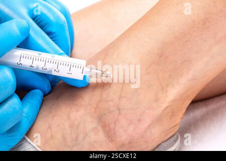 Ablation des varices sur les jambes. Inspection médicale et traitement des télangiectasies. Phlébeurysme. Banque D'Images