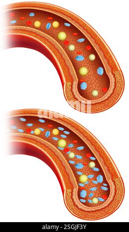 Schéma artériel, où dans l'un il y a hyperglycémie due à l'augmentation anormale de la glycémie, causée par le diabète, l'autre est normal. Banque D'Images