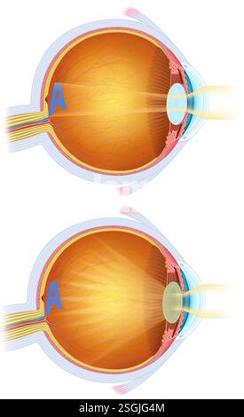 Illustration de deux images du foyer visuel de l'œil. l’un est normal et l’autre avec cataracte oculaire, opacification progressive du cristallin. Banque D'Images