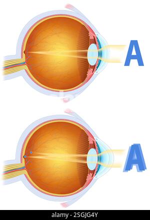 Illustration composée de deux images de l’œil, normale et astigmatisée, il s’agit d’une vision floue due à une courbure irrégulière de la cornée. Banque D'Images