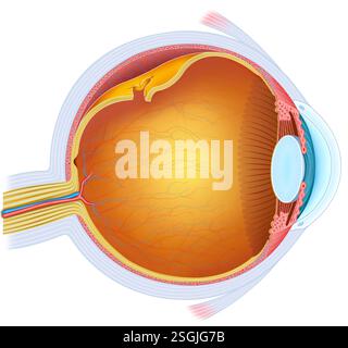 Représentation du décollement de la rétine. Urgence oculaire où la rétine se sépare de la choroïde, causant une perte de vision et nécessitant un traitement immédiat. Banque D'Images