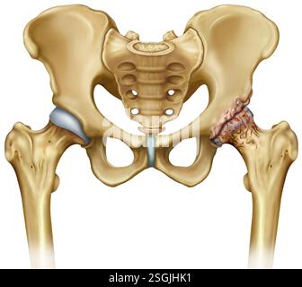 Schéma de l'arthrose, une maladie dégénérative qui affecte les articulations et limite les mouvements. Banque D'Images