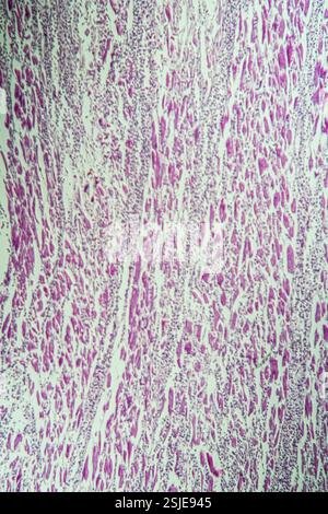 Muscle cardiaque enflammé sous le microscope 100x Banque D'Images