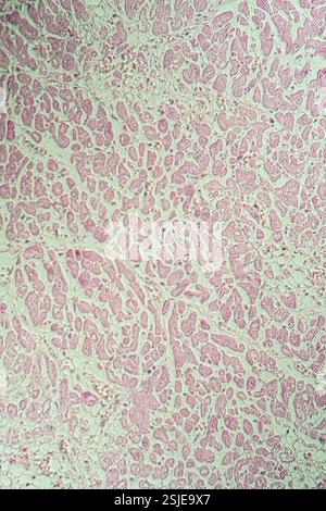 Muscle cardiaque tissu malade sous le microscope 200x Banque D'Images