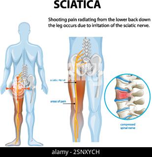 Illustration de la douleur sciatique et des zones touchées Illustration de Vecteur