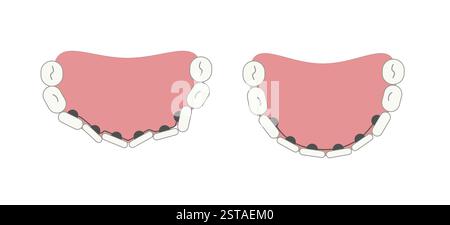 Attelles linguales dans la bouche à la surface interne de la dent avant et après la carte. Image géométrique plate simple médicale. Illustration de Vecteur