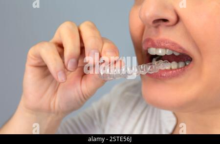 Image anonyme en gros plan d'une personne insérant un aligneur dentaire transparent, mettant en évidence le traitement orthodontique moderne Banque D'Images
