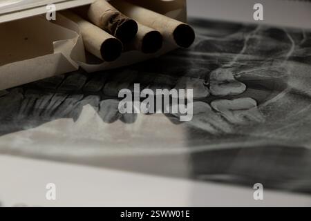 Les cigarettes reposent sur une radiographie dentaire panoramique, les caries de nicotine, les dents de mauvais fumeur Banque D'Images