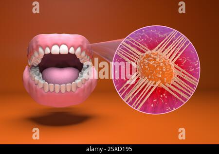 Cancer de la bouche (langue, cavité buccale) - vue isométrique 3d illustration Banque D'Images
