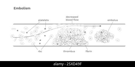 Schéma médical de l'embolie. Mouvement du caillot sanguin dans le vaisseau sanguin Illustration de Vecteur