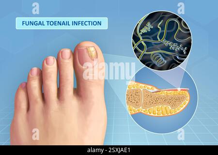 Diagramme montrant les pathogènes fongiques dans un ongle d'orteil. Illustration numérique. Banque D'Images