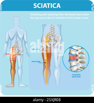 Illustration de la douleur sciatique et des zones touchées Illustration de Vecteur