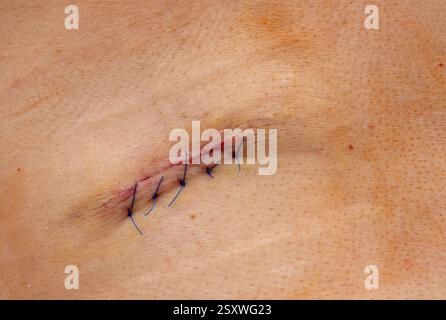 Suture médicale sur peau humaine après chirurgie. Cicatrice des points de suture cosmétiques. Traitement avec un désinfectant à base d'iode Banque D'Images
