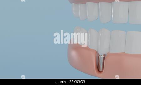 Modèle 3D de dents sur la mâchoire et un implant dentaire implanté dans la gencive sur fond bleu, dentisterie, prothèses et soins Banque D'Images