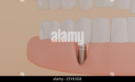 Modèle 3D de dents sur la mâchoire et un implant dentaire implanté dans la gencive sur fond beige, dentisterie, prothèses et soins Banque D'Images