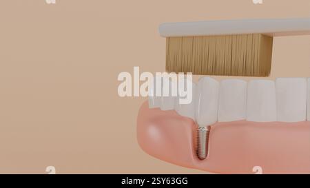 Modèle 3D de dents sur la mâchoire et un implant dentaire implanté dans la gencive et une brosse à dents sur fond beige, dentisterie, prothèses et soins Banque D'Images
