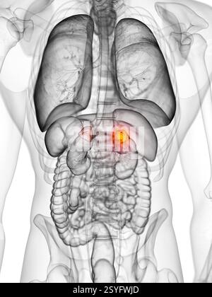 Cancer de la glande surrénale, illustration. Banque D'Images