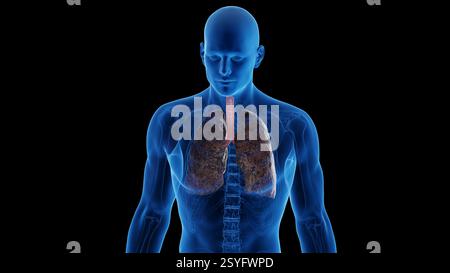 Poumons du fumeur, illustration. Banque D'Images