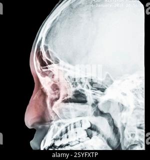 Radiographie colorée de la tête d'un patient ayant le nez cassé. Banque D'Images