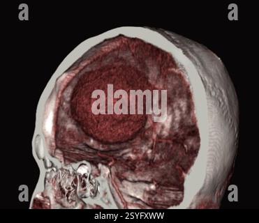 Tomodensitométrie (TDM) couleur de la tête d'un patient montrant un méningiome (sphère rouge). Il s’agit d’une tumeur bénigne (non cancéreuse) qui provient des méninges, les membranes qui entourent le cerveau. Banque D'Images