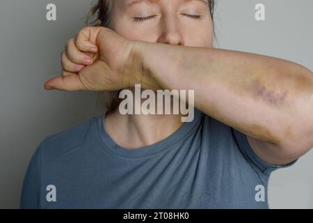 Jolie jeune femme avec ecchymose de blessure sur sa main, portrait en gros plan. Banque D'Images