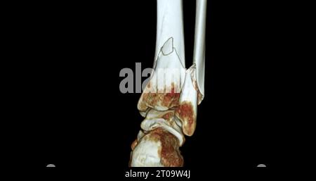 Image de rendu 3D de l'articulation de la cheville par tomodensitométrie montrant la fracture du tibia et du péroné. Banque D'Images