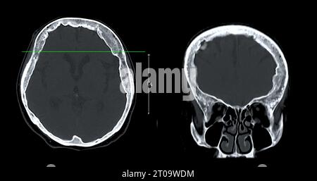 Acquisition CT de la vue sagittale du cerveau pour le diagnostic des tumeurs cérébrales, des maladies cérébrales et des maladies vasculaires. Banque D'Images