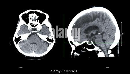 Acquisition CT de la vue sagittale du cerveau pour le diagnostic des tumeurs cérébrales, des maladies cérébrales et des maladies vasculaires. Banque D'Images