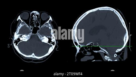 Acquisition CT de la vue sagittale du cerveau pour le diagnostic des tumeurs cérébrales, des maladies cérébrales et des maladies vasculaires. Banque D'Images