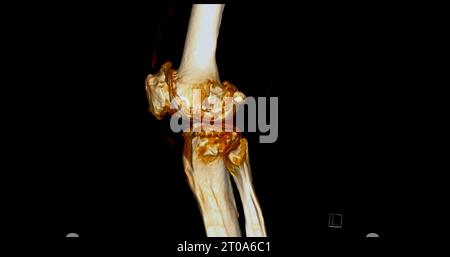 Scanner de l'articulation du genou montrant un rendu 3D de fracture tibia et péroné. Banque D'Images