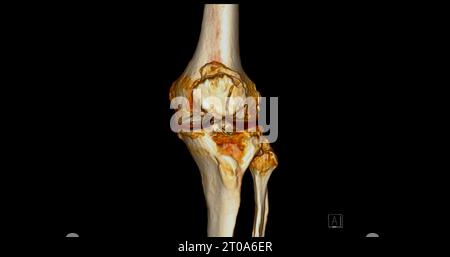 Scanner de l'articulation du genou montrant un rendu 3D de fracture tibia et péroné. Banque D'Images