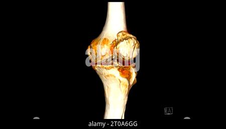 Scanner de l'articulation du genou montrant un rendu 3D de fracture tibia et péroné. Banque D'Images