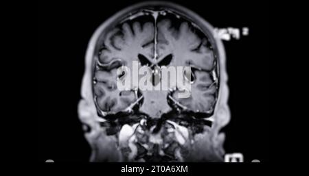 IRM scanner du cerveau pour détecter les maladies du cerveau sush comme maladie d'accident vasculaire cérébral, tumeurs du cerveau et infections. Banque D'Images