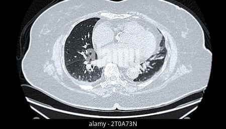 Tomodensitométrie de la vue axiale thorax pour le diagnostic d'embolie pulmonaire (EP), de cancer du poumon et de covid-19. Banque D'Images