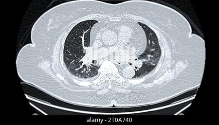 Tomodensitométrie de la vue axiale thorax pour le diagnostic d'embolie pulmonaire (EP), de cancer du poumon et de covid-19. Banque D'Images