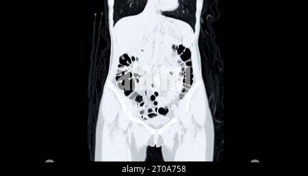 Vue coronale de la coloscopie TDM. Contexte médical. Banque D'Images