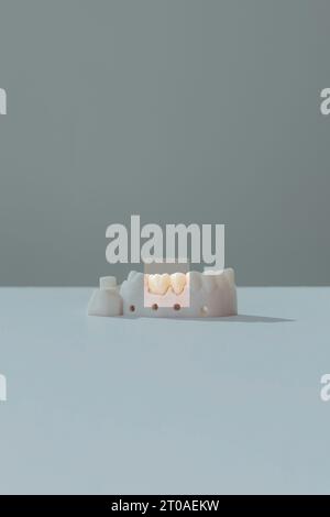 Concevez la couronne de dent ou le capuchon dentaire sur le support de dent de modèle d'implant. Préparation de la dent molaire pour la mise en place du Bridge. Plan vertical, Copier l'espace pour le texte Banque D'Images