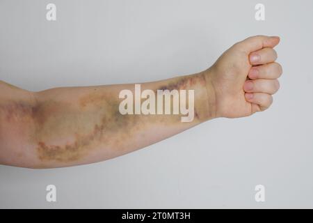 Main féminine avec cicatrice d'accident de voiture et ecchymose Banque D'Images