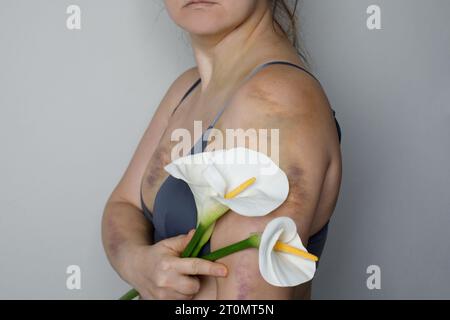 Blessure à la cuisse due à une collision, un impact ou une chute, ecchymose de la peau de la femme. Ecchymose sur les gens Banque D'Images