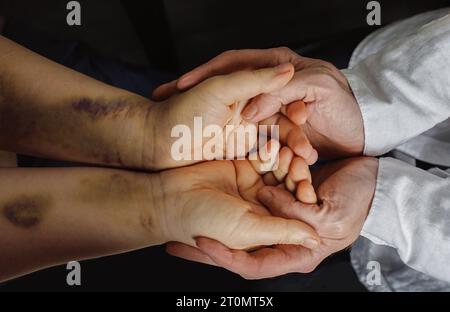 Docteur nand tenant la main du patient avec des ecchymoses traumatiques à l'hôpital ou dans un abri. Concept de soutien médical et social. Banque D'Images